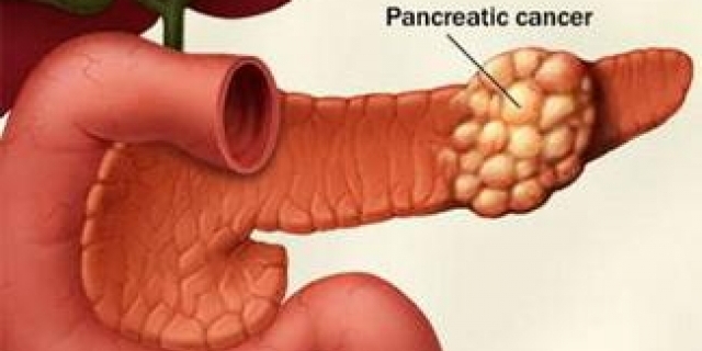胰腺癌